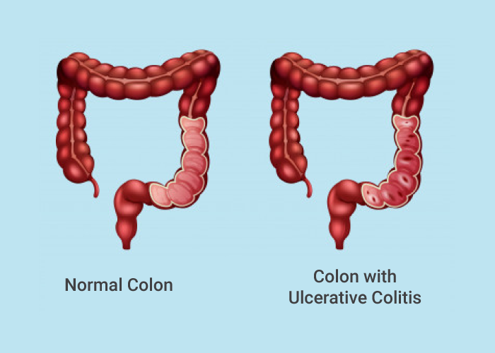 Ulcerative Colitis