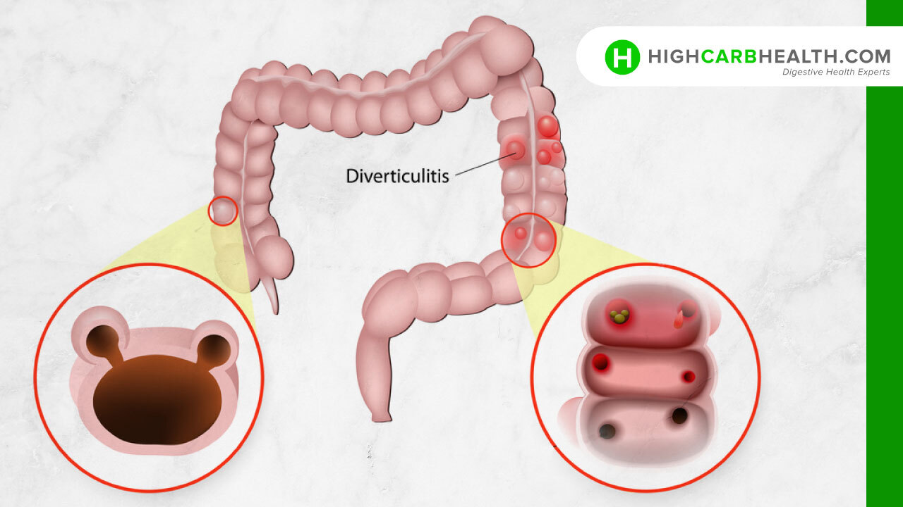 What is Diverticulitis - High Carb Health