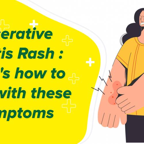 Ulcerative Colitis Rash: Here’s How to Deal with these Symptoms