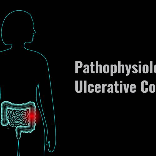 Pathophysiology of Ulcerative Colitis