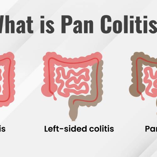What is Pancolitis ?